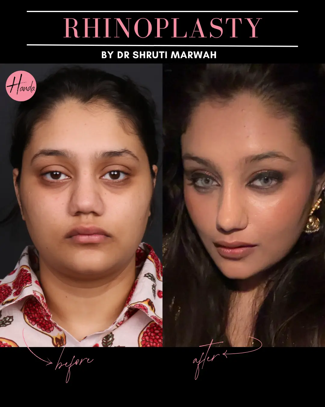 RHINOPLASTY before and after — Handa Aesthetics