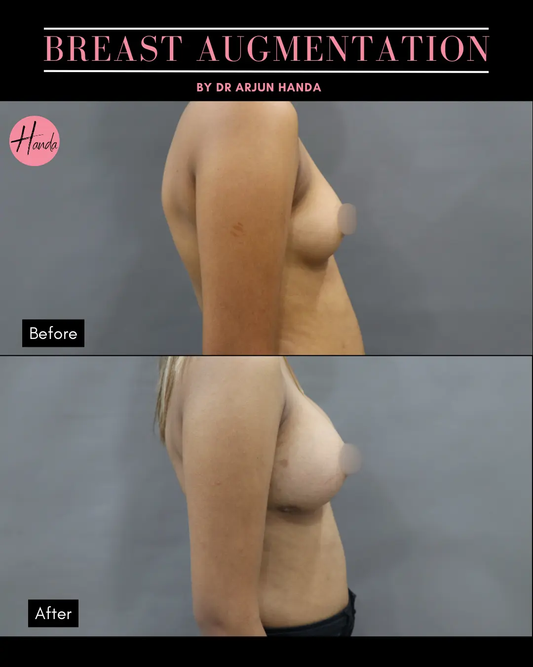 BREAST AUGMENTATION before and after — Handa Aesthetics