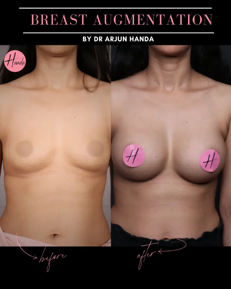 BREAST AUGMENTATION before and after — Handa Aesthetics