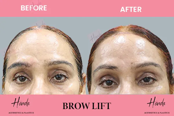 BROW LIFT before and after — Handa Aesthetics