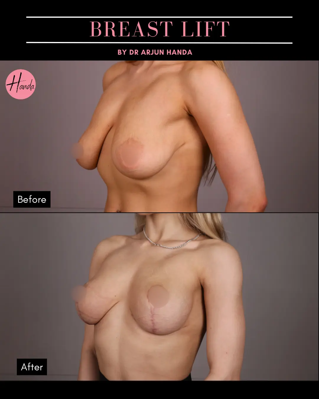 BREAST REDUCTION AND LIFT before and after — Handa Aesthetics