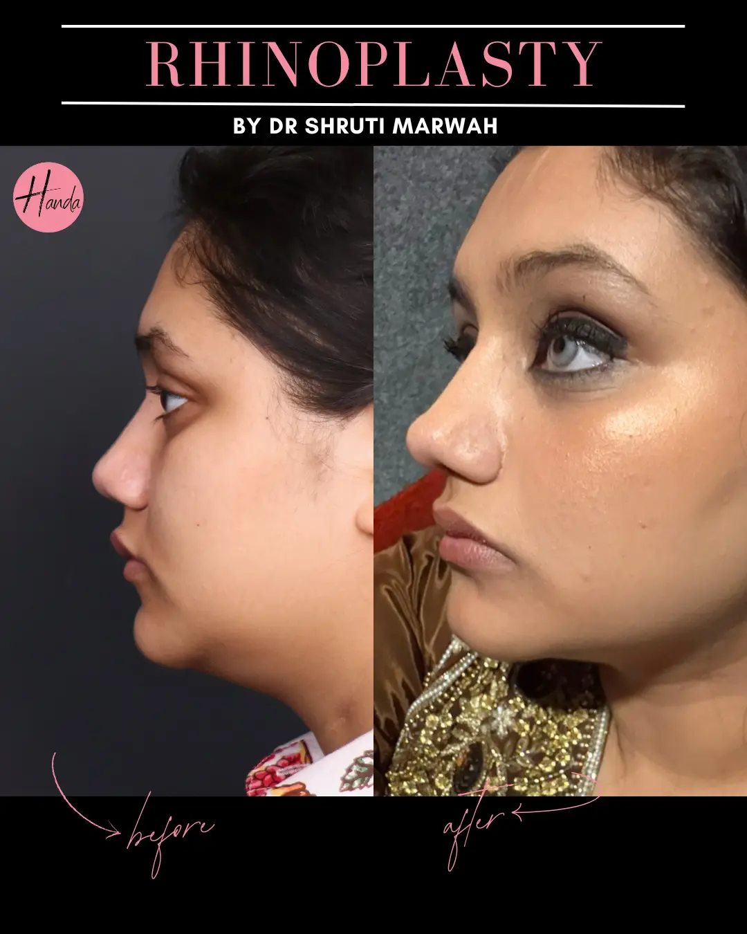 RHINOPLASTY before and after — Handa Aesthetics