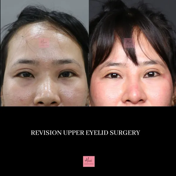 Face before and after — Handa Aesthetics