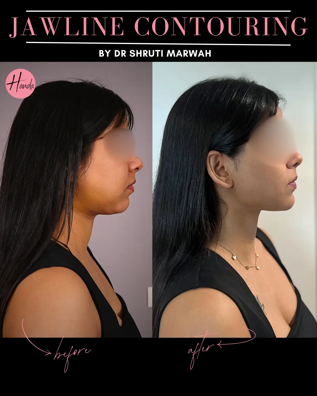 CHIN & JAWLINE LIPOSUCTION before and after — Handa Aesthetics