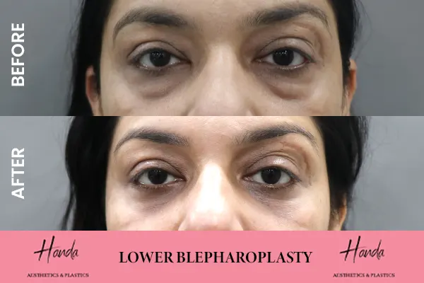 LOWER BLEPHAROPLASTY before and after — Handa Aesthetics