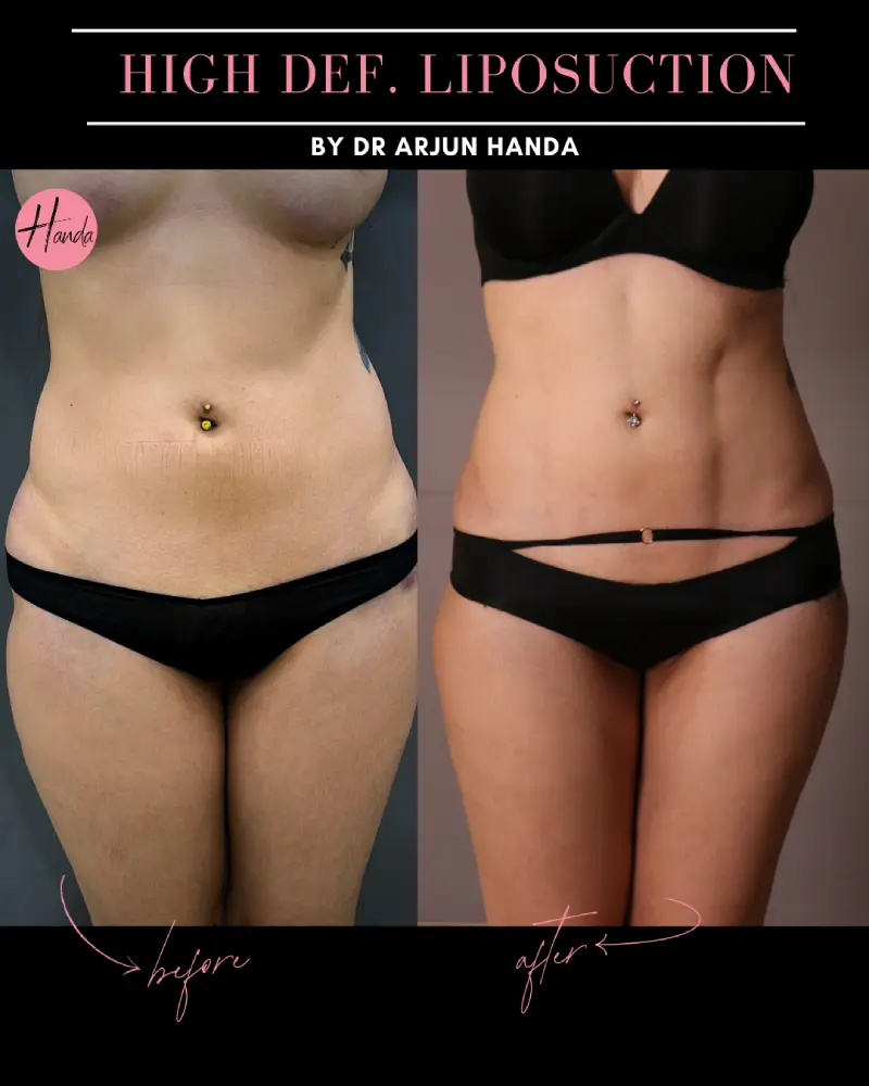 Liposuction before and after — Handa Aesthetics