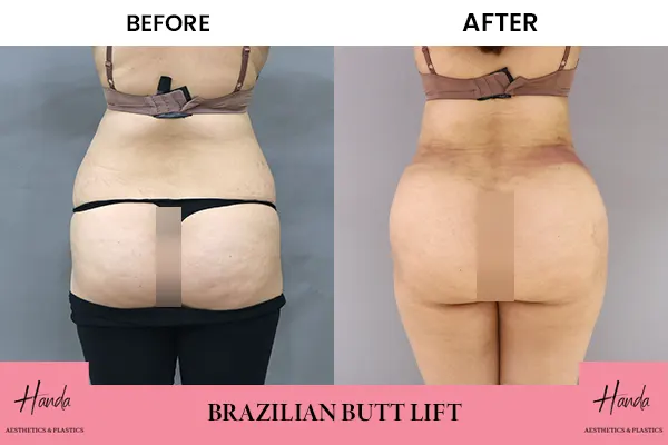 Butt Lift before and after — Handa Aesthetics