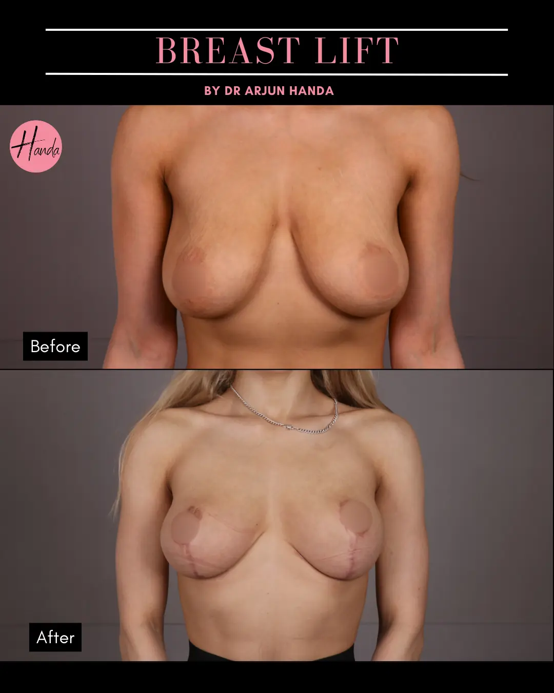 BREAST REDUCTION AND LIFT before and after — Handa Aesthetics