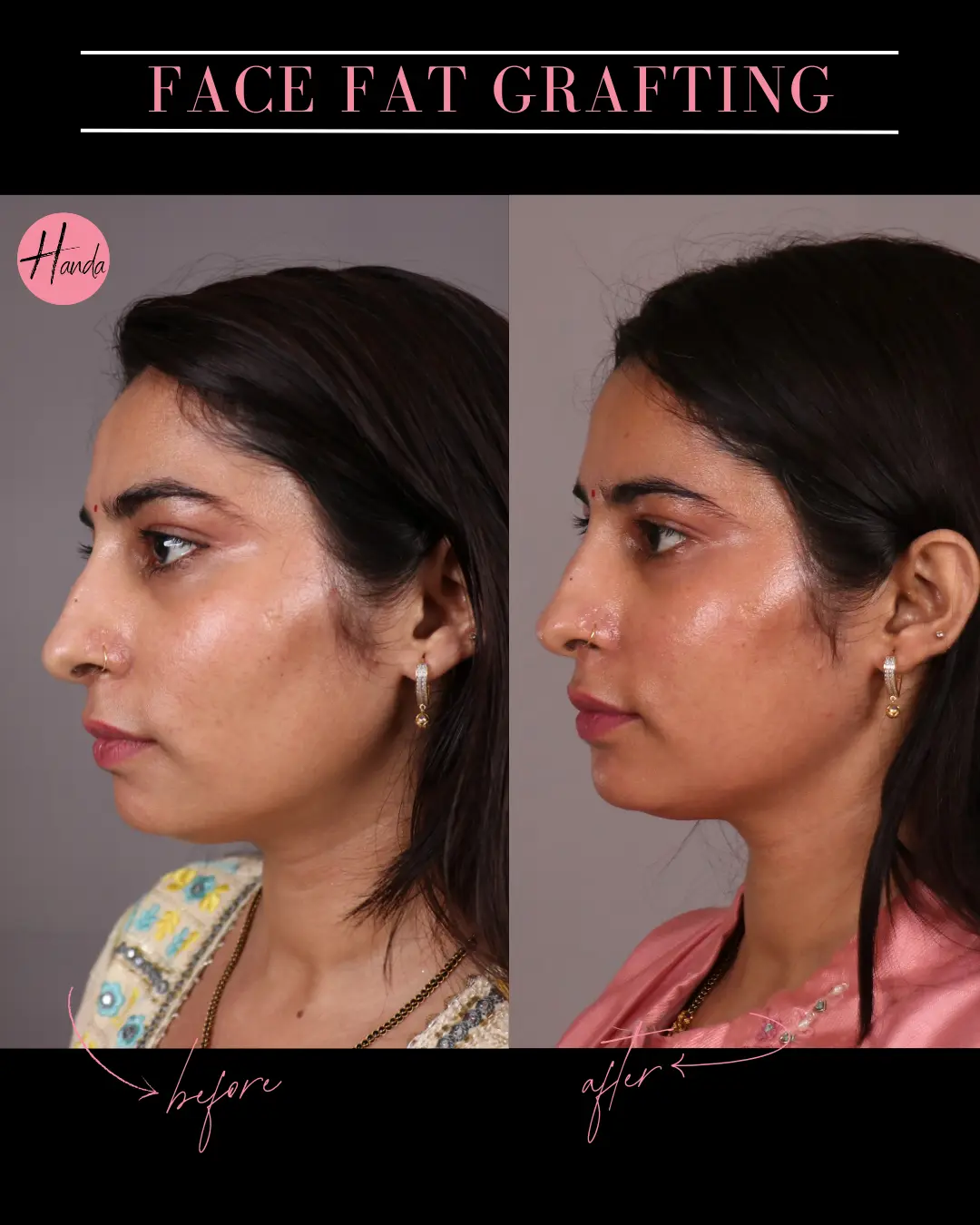 FACIAL FAT GRAFTING before and after — Handa Aesthetics