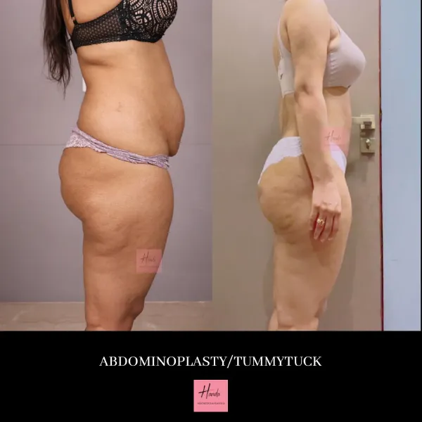 Tummy Tuck (Full Abdominoplasty) before and after — Handa Aesthetics