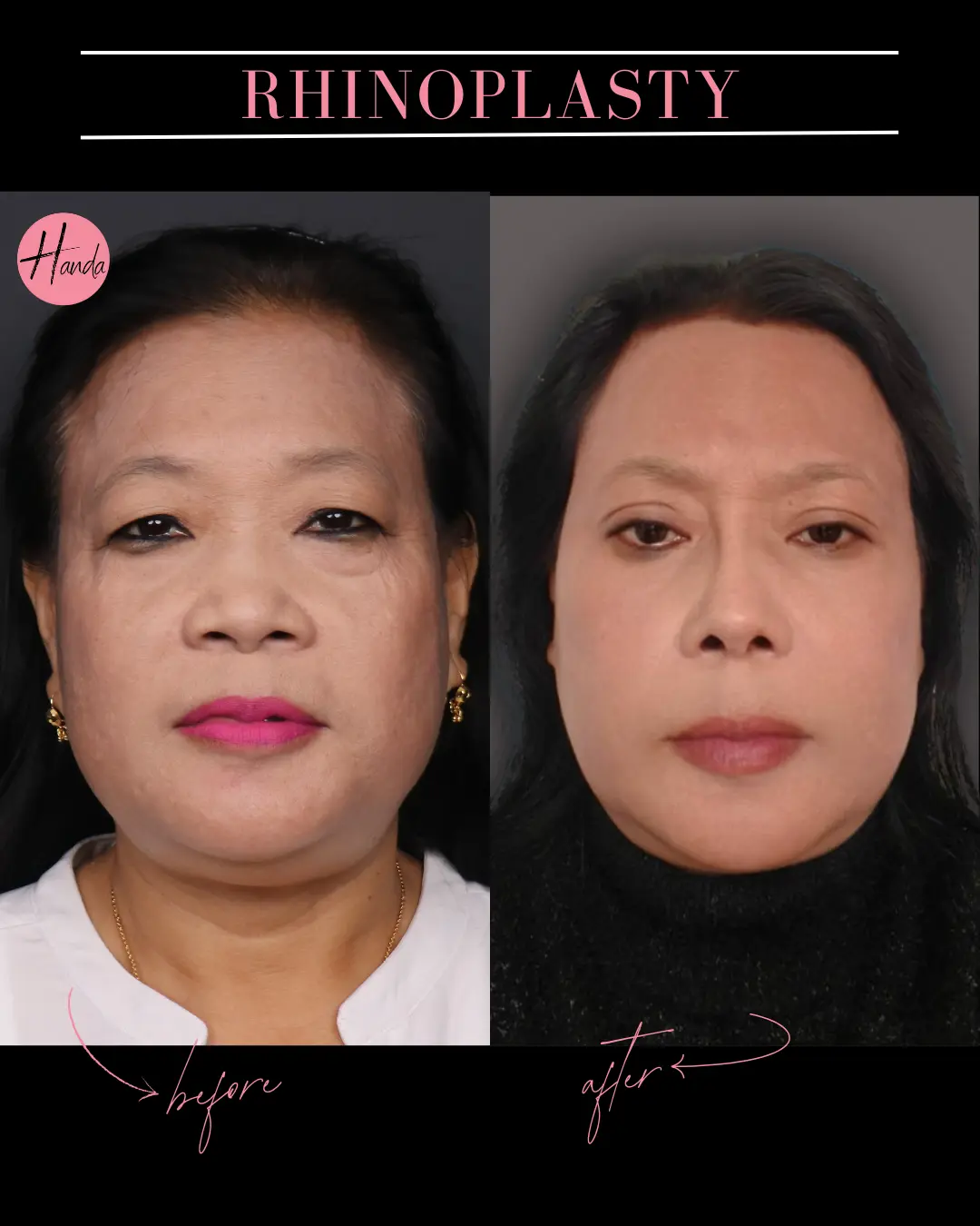 RHINOPLASTY before and after — Handa Aesthetics