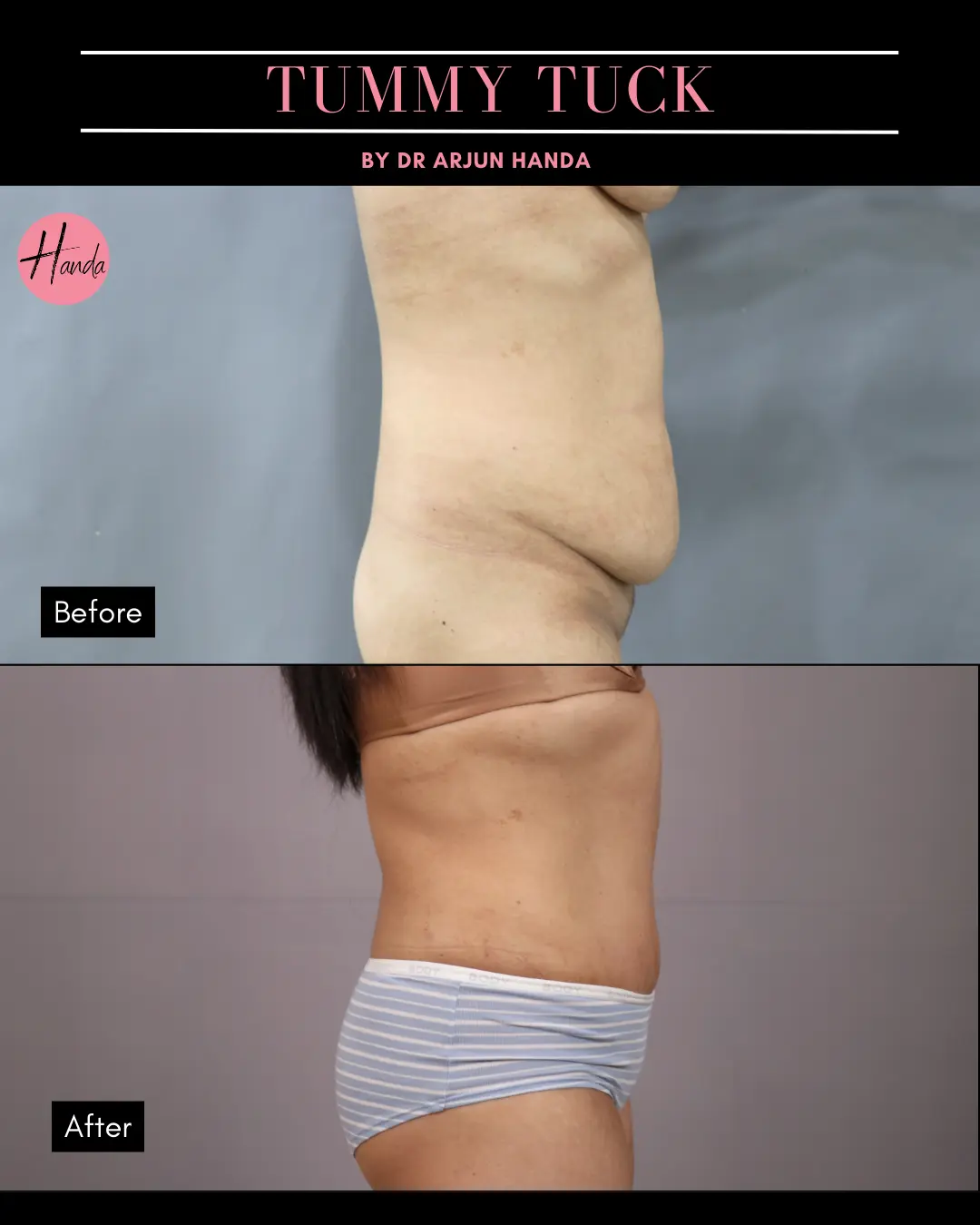 Tummy Tuck (Full Abdominoplasty) before and after — Handa Aesthetics