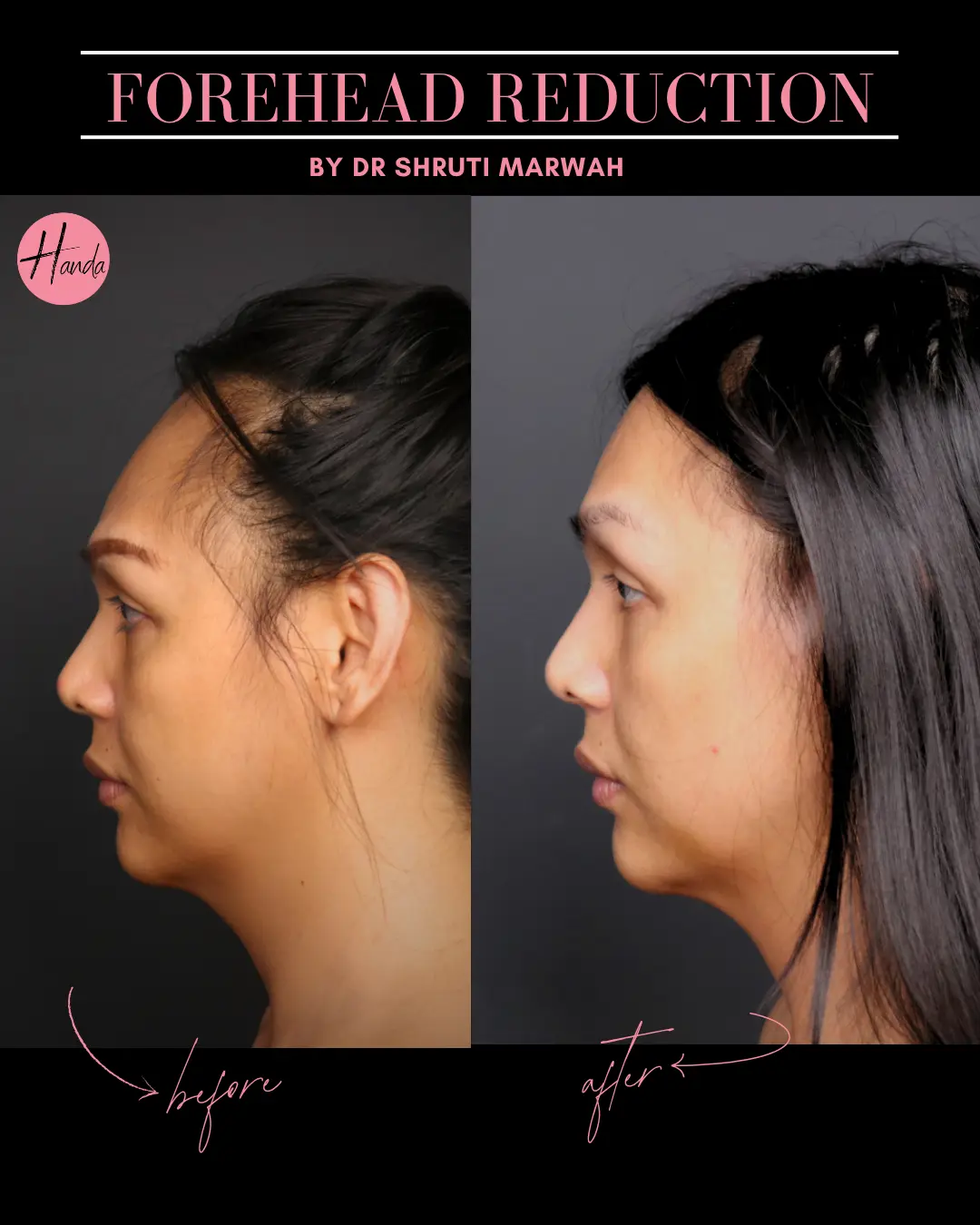 FOREHEAD REDUCTION before and after — Handa Aesthetics