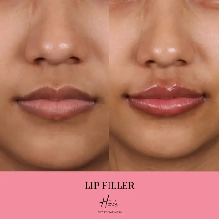 Body Contouring before and after — Handa Aesthetics