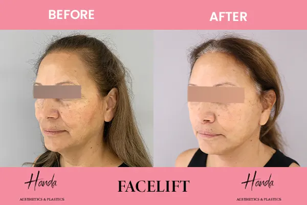 FACE LIFT before and after — Handa Aesthetics