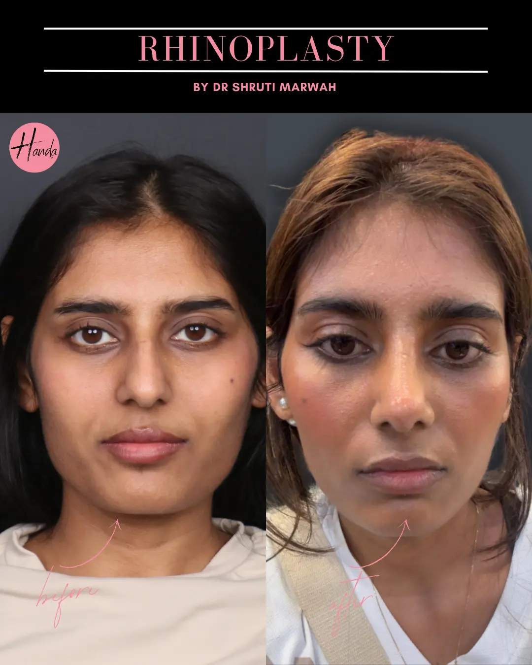 RHINOPLASTY before and after — Handa Aesthetics