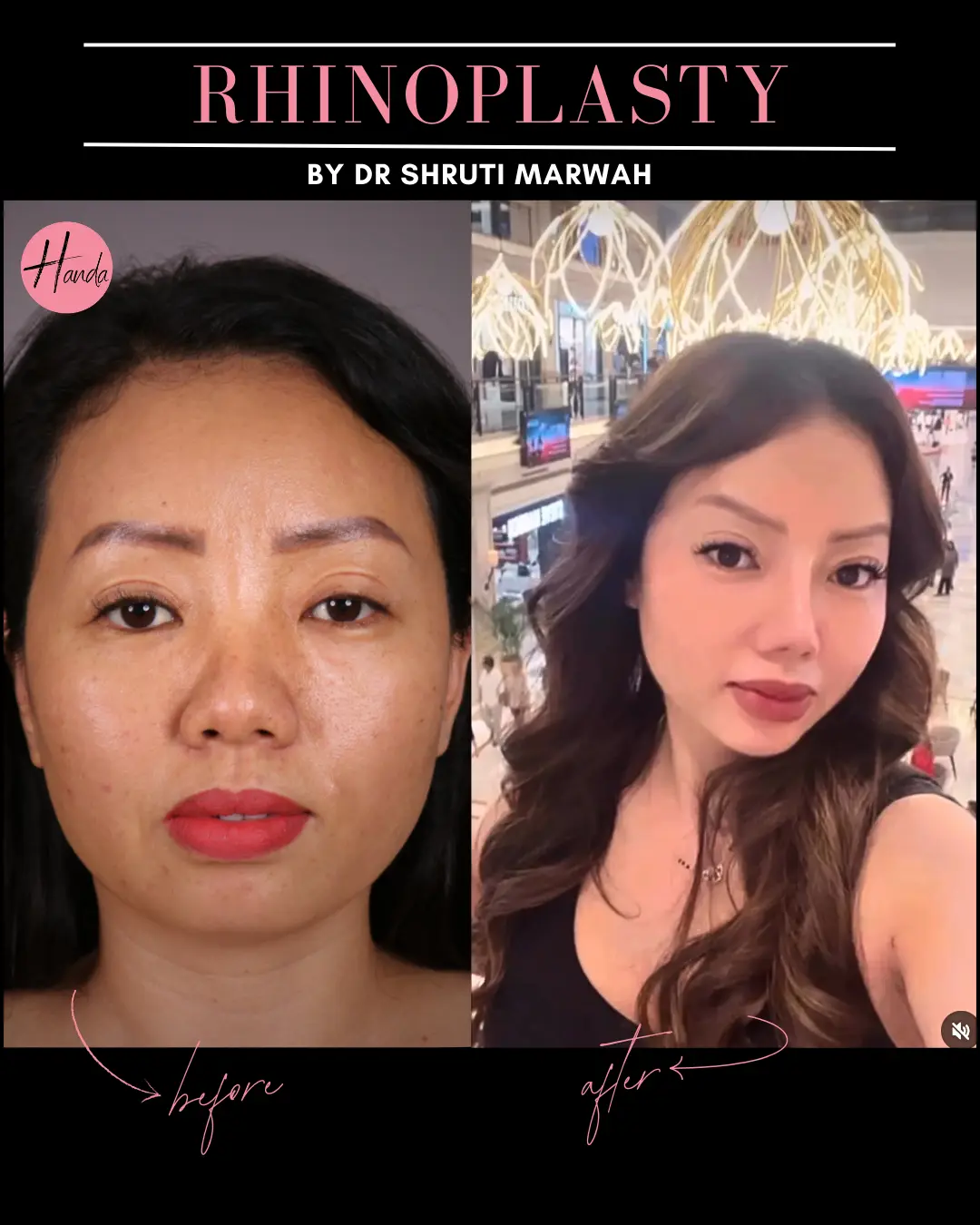 RHINOPLASTY before and after — Handa Aesthetics