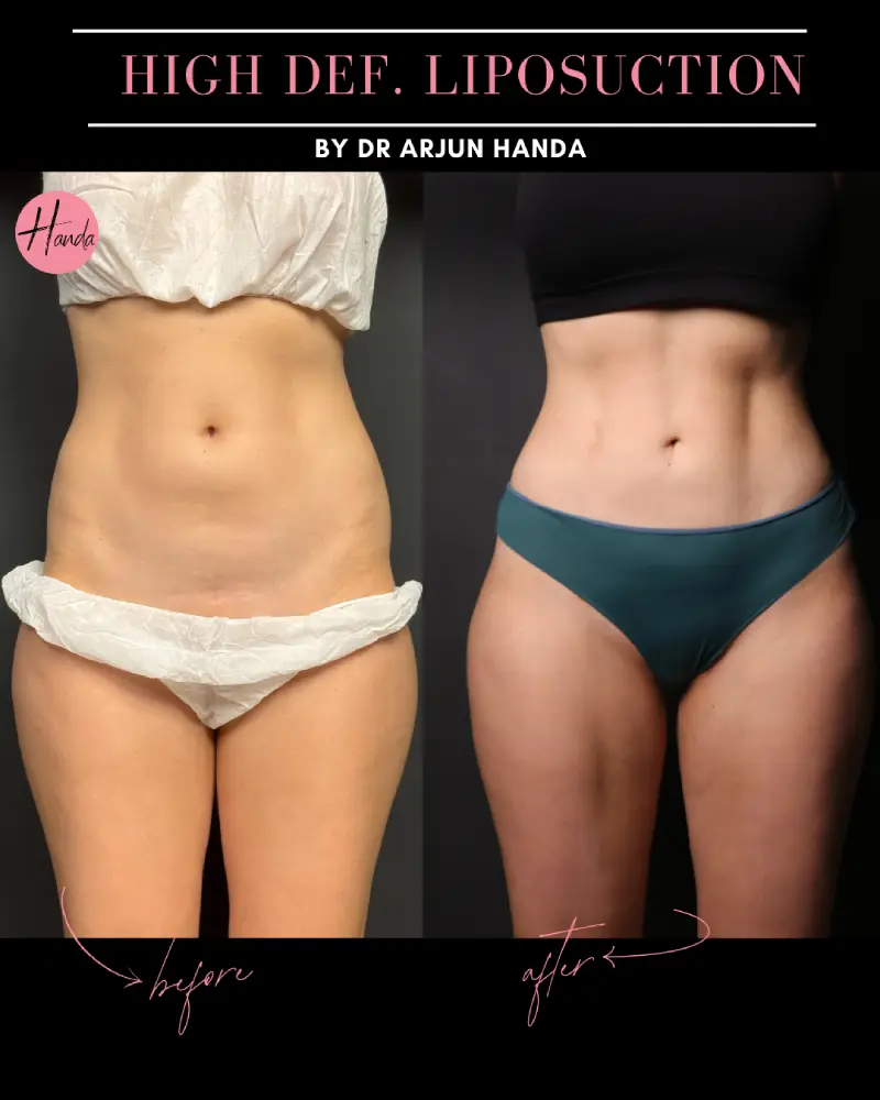 Liposuction before and after — Handa Aesthetics