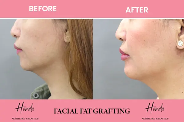 FACIAL FAT GRAFTING before and after — Handa Aesthetics