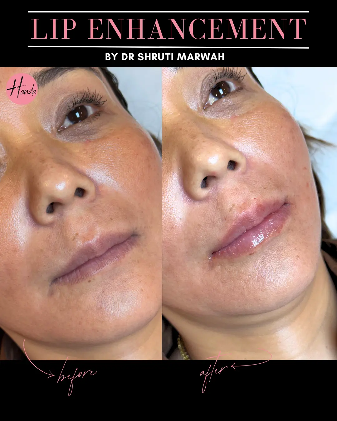 Body Contouring before and after — Handa Aesthetics