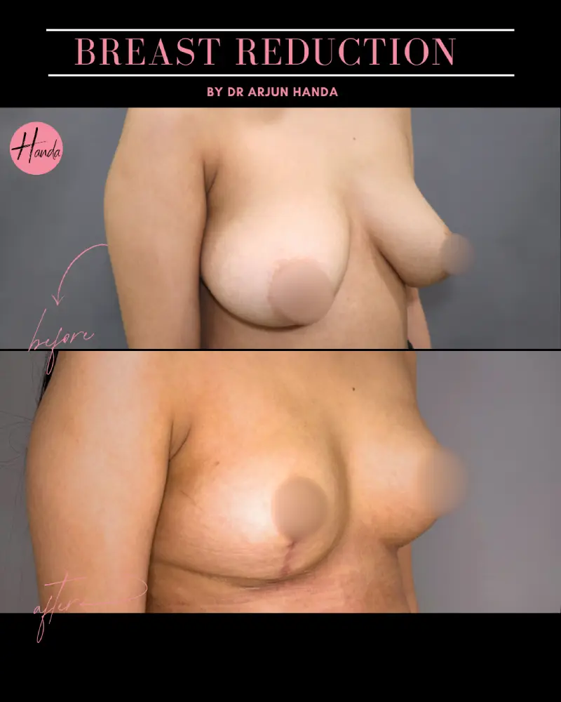 BREAST REDUCTION AND LIFT before and after — Handa Aesthetics