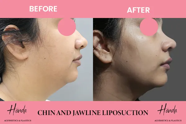 CHIN & JAWLINE LIPOSUCTION before and after — Handa Aesthetics