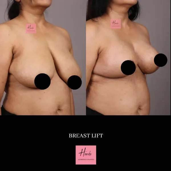 BREAST REDUCTION AND LIFT before and after — Handa Aesthetics