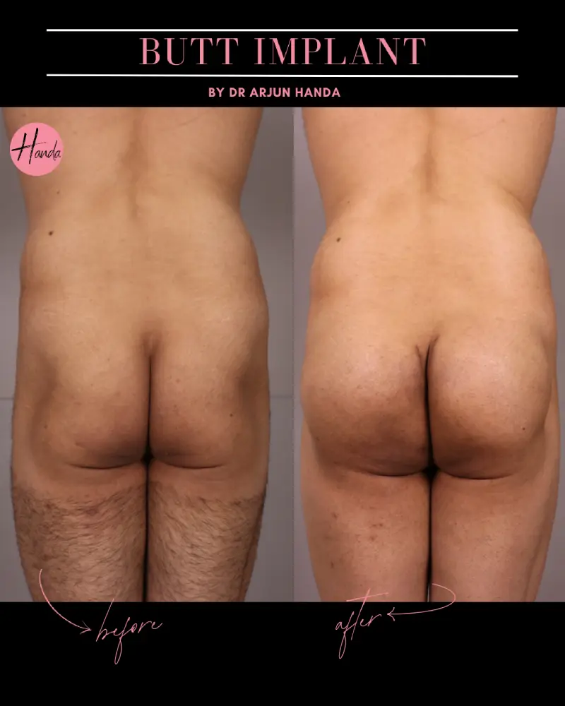 Butt Lift before and after — Handa Aesthetics