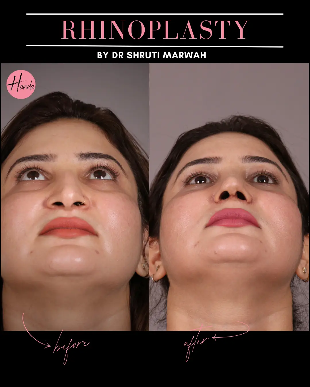RHINOPLASTY before and after — Handa Aesthetics