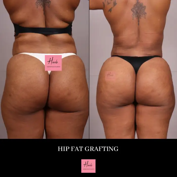 Butt Lift before and after — Handa Aesthetics