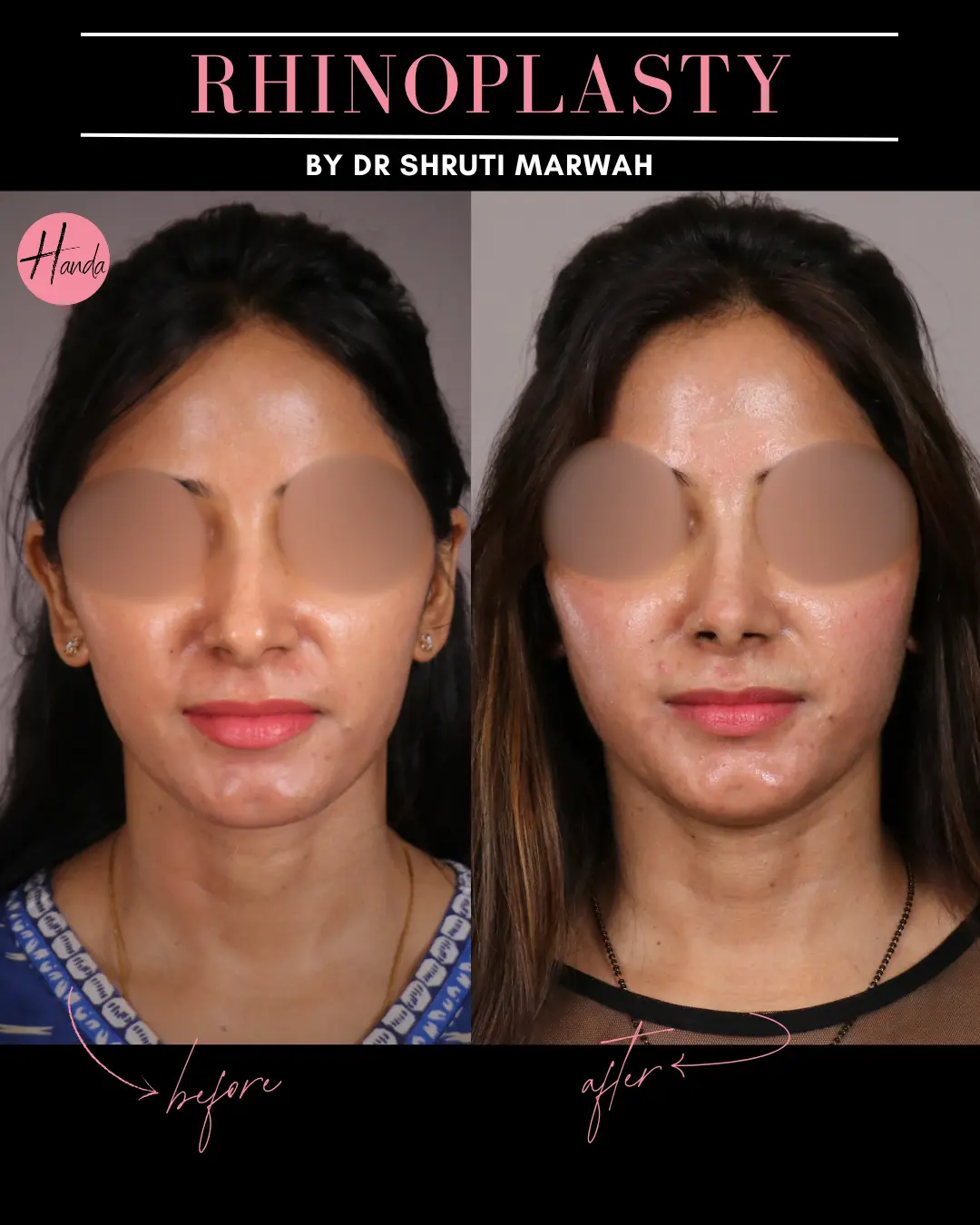 RHINOPLASTY before and after — Handa Aesthetics