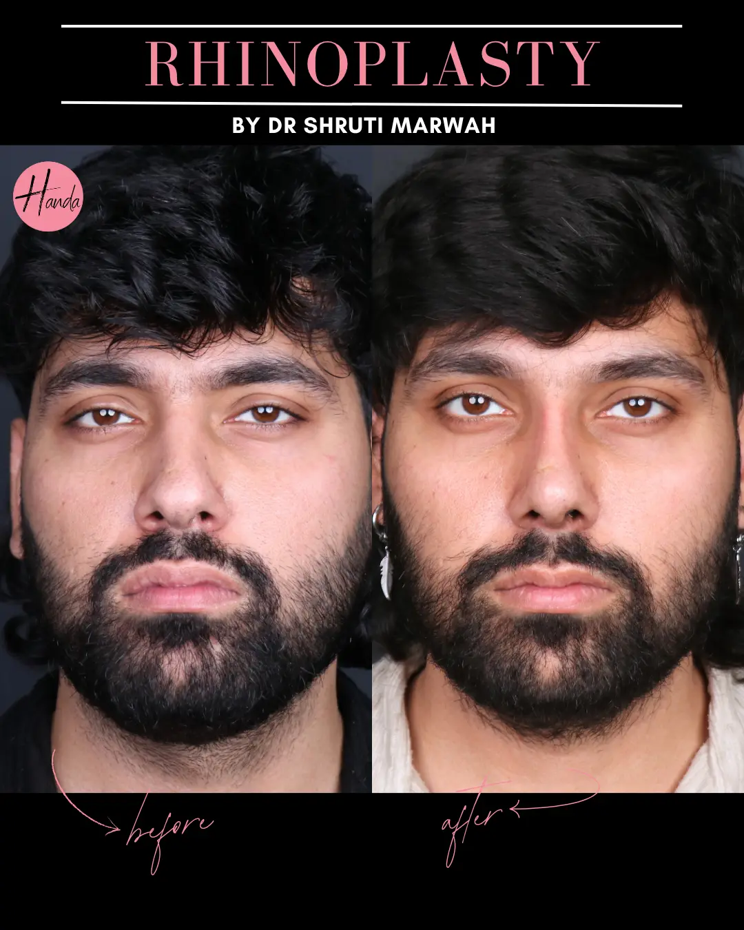 RHINOPLASTY before and after — Handa Aesthetics