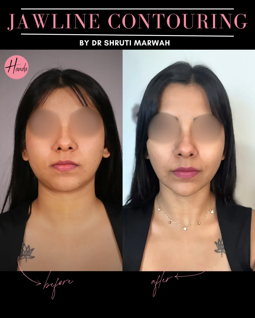 CHIN & JAWLINE LIPOSUCTION before and after — Handa Aesthetics