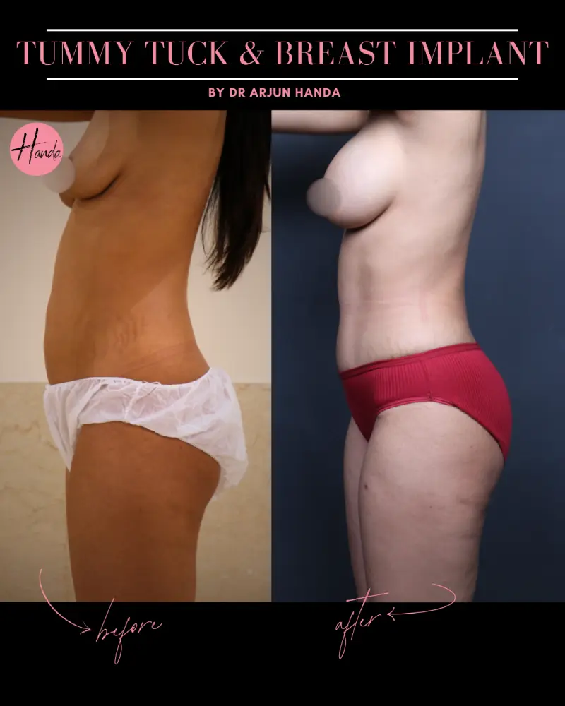 BREAST IMPLANT before and after — Handa Aesthetics