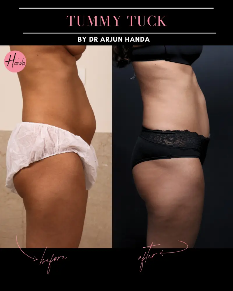 Tummy Tuck (Full Abdominoplasty) before and after — Handa Aesthetics