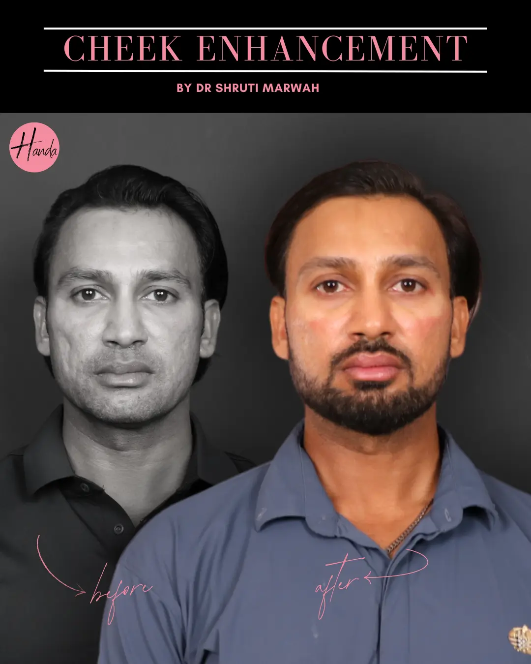 CHEEK ENHANCEMENT before and after — Handa Aesthetics