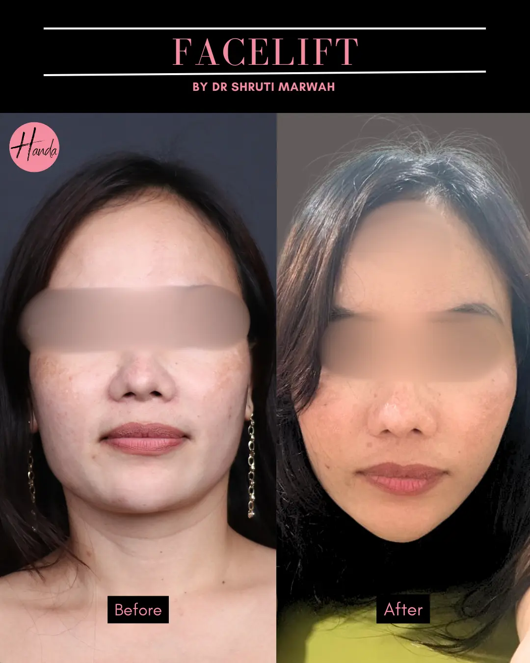 FACE LIFT before and after — Handa Aesthetics