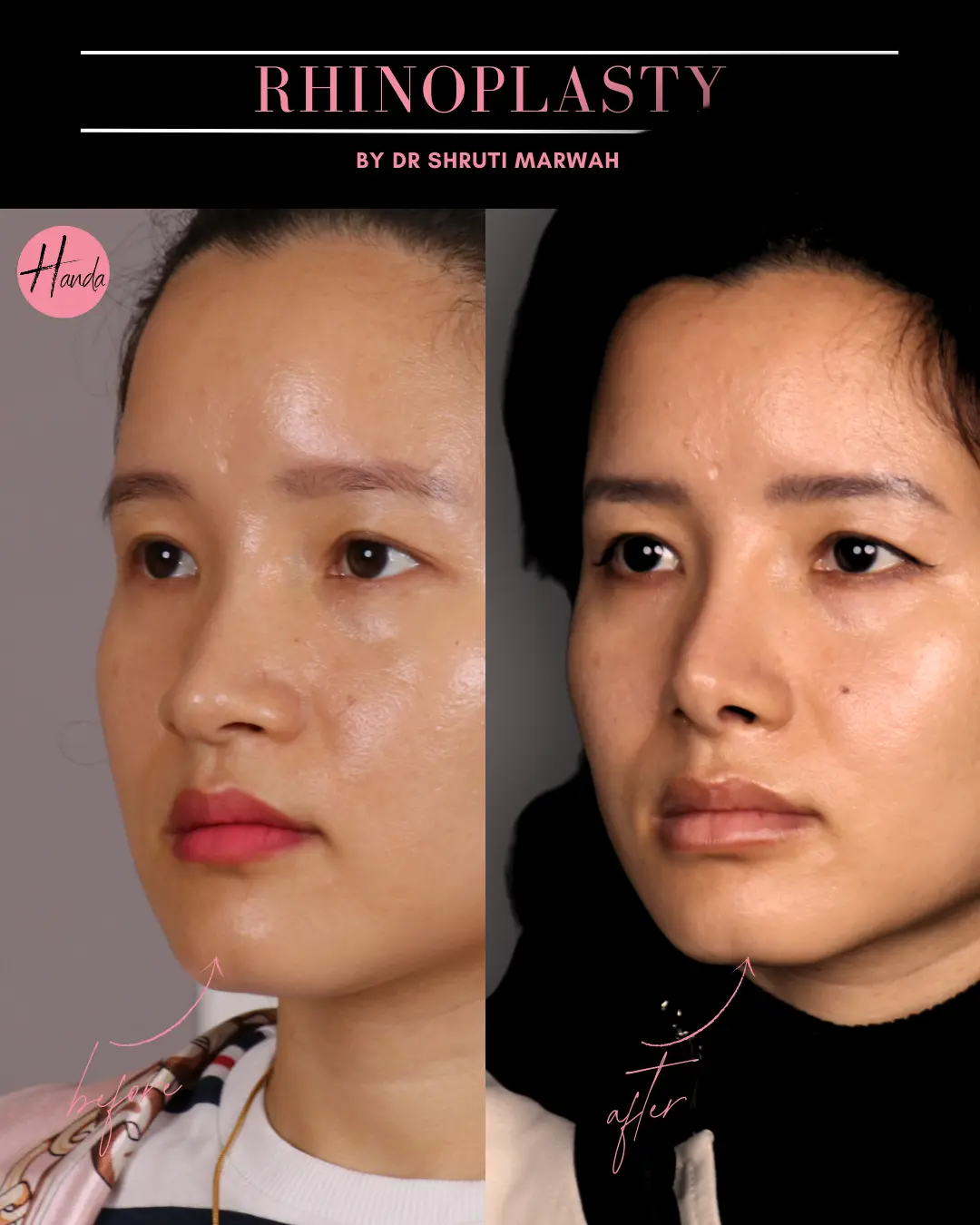 RHINOPLASTY before and after — Handa Aesthetics