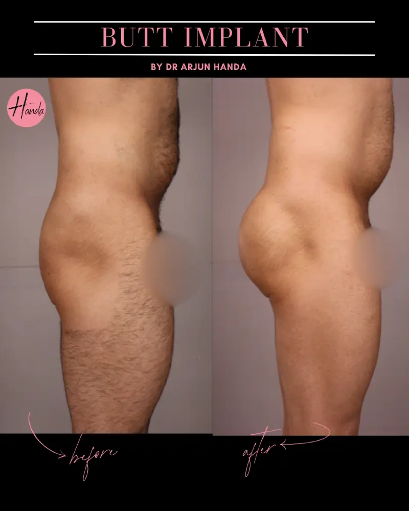 Butt Lift before and after — Handa Aesthetics
