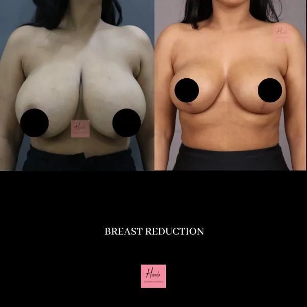 BREAST REDUCTION AND LIFT before and after — Handa Aesthetics