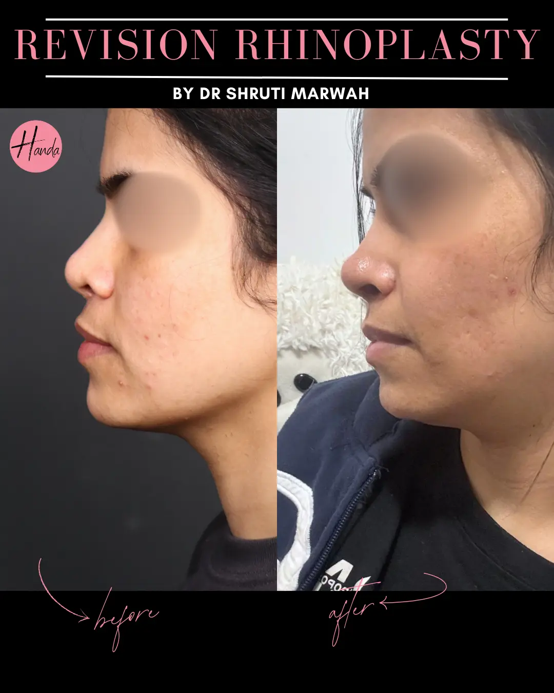 RHINOPLASTY before and after — Handa Aesthetics