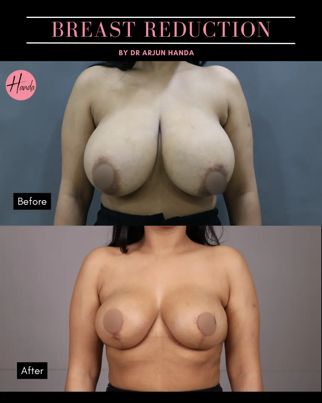 BREAST REDUCTION AND LIFT before and after — Handa Aesthetics