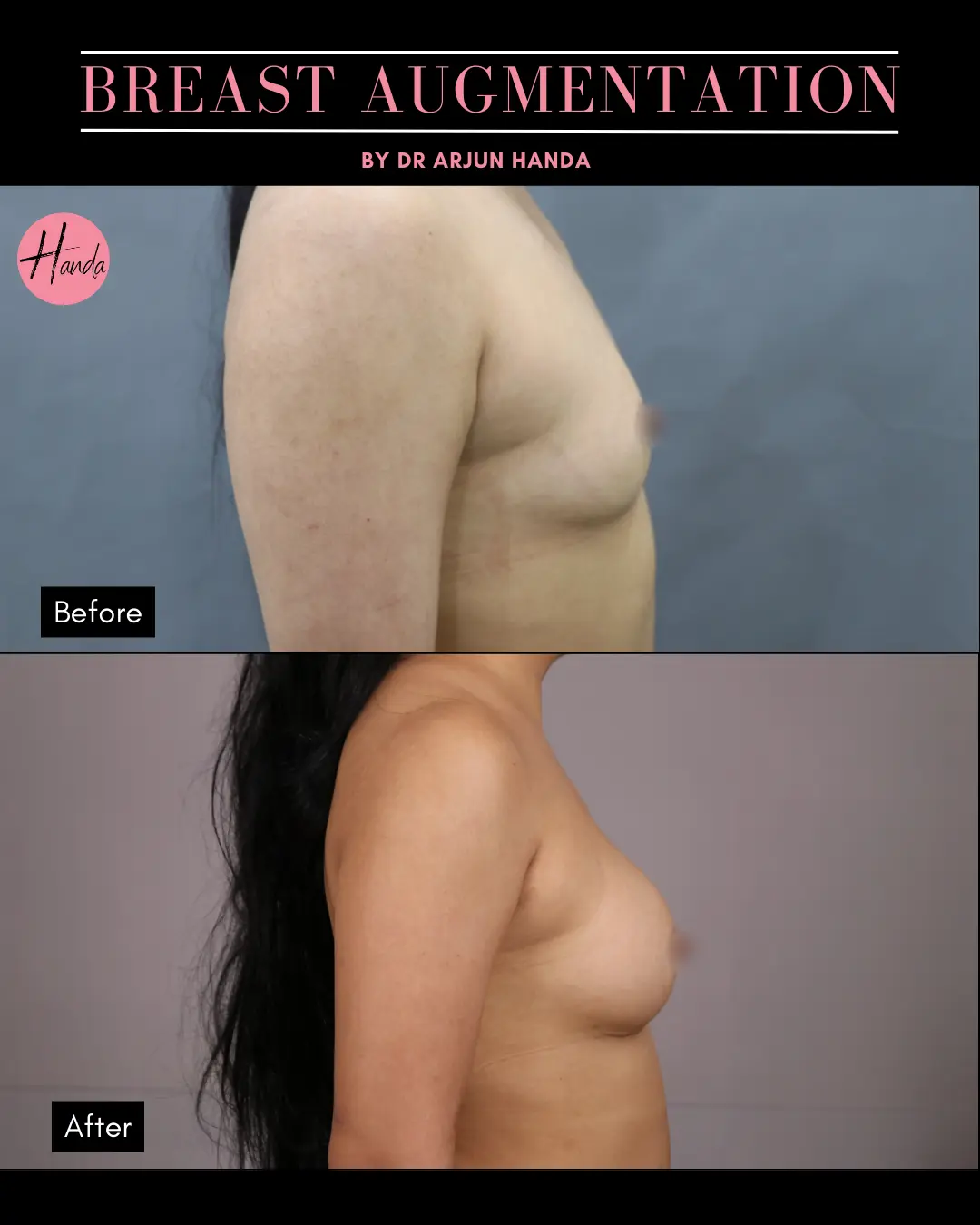 BREAST AUGMENTATION before and after — Handa Aesthetics