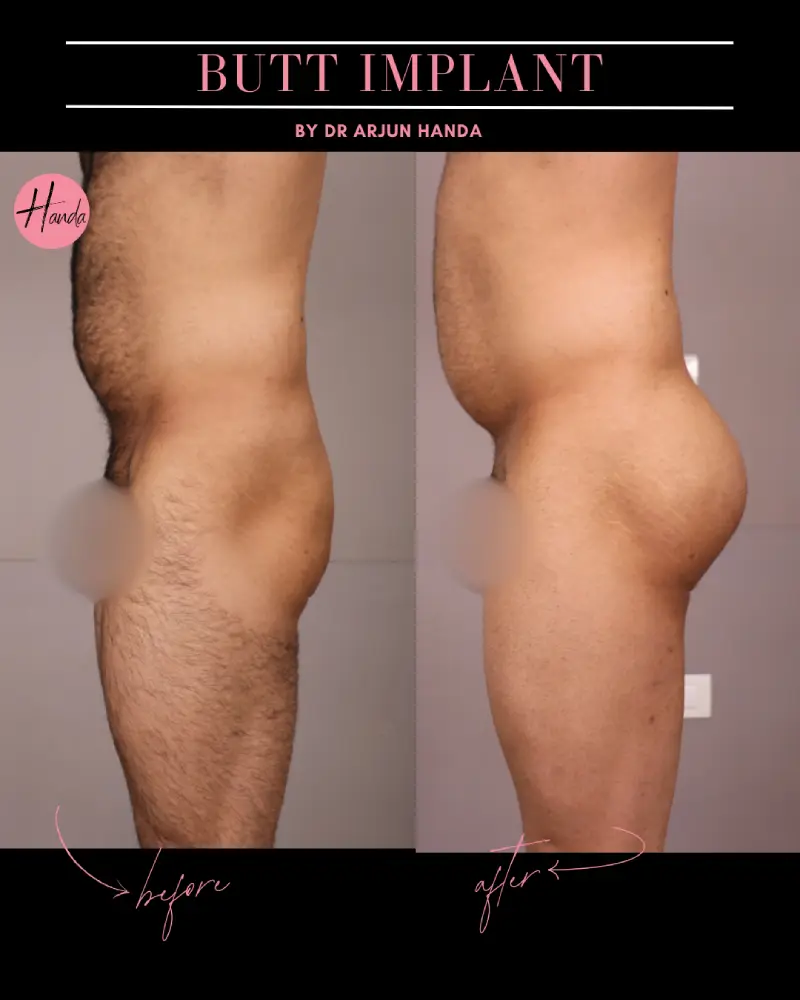 Butt Lift before and after — Handa Aesthetics
