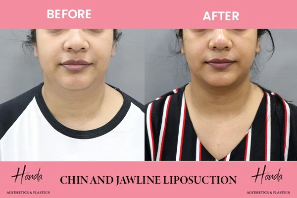CHIN & JAWLINE LIPOSUCTION before and after — Handa Aesthetics