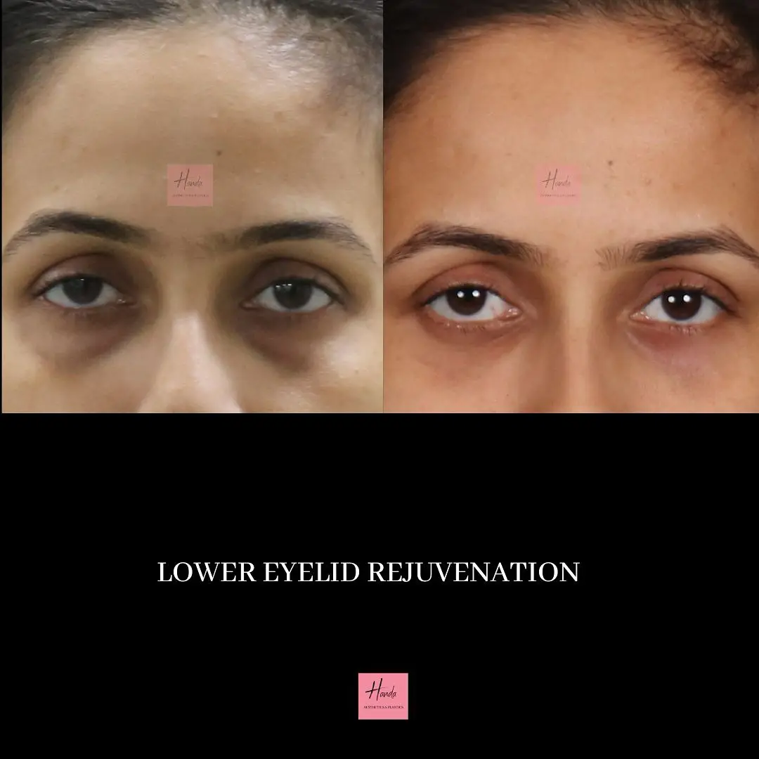 LOWER EYELID before and after — Handa Aesthetics