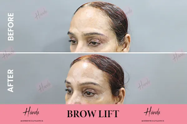 BROW LIFT before and after — Handa Aesthetics