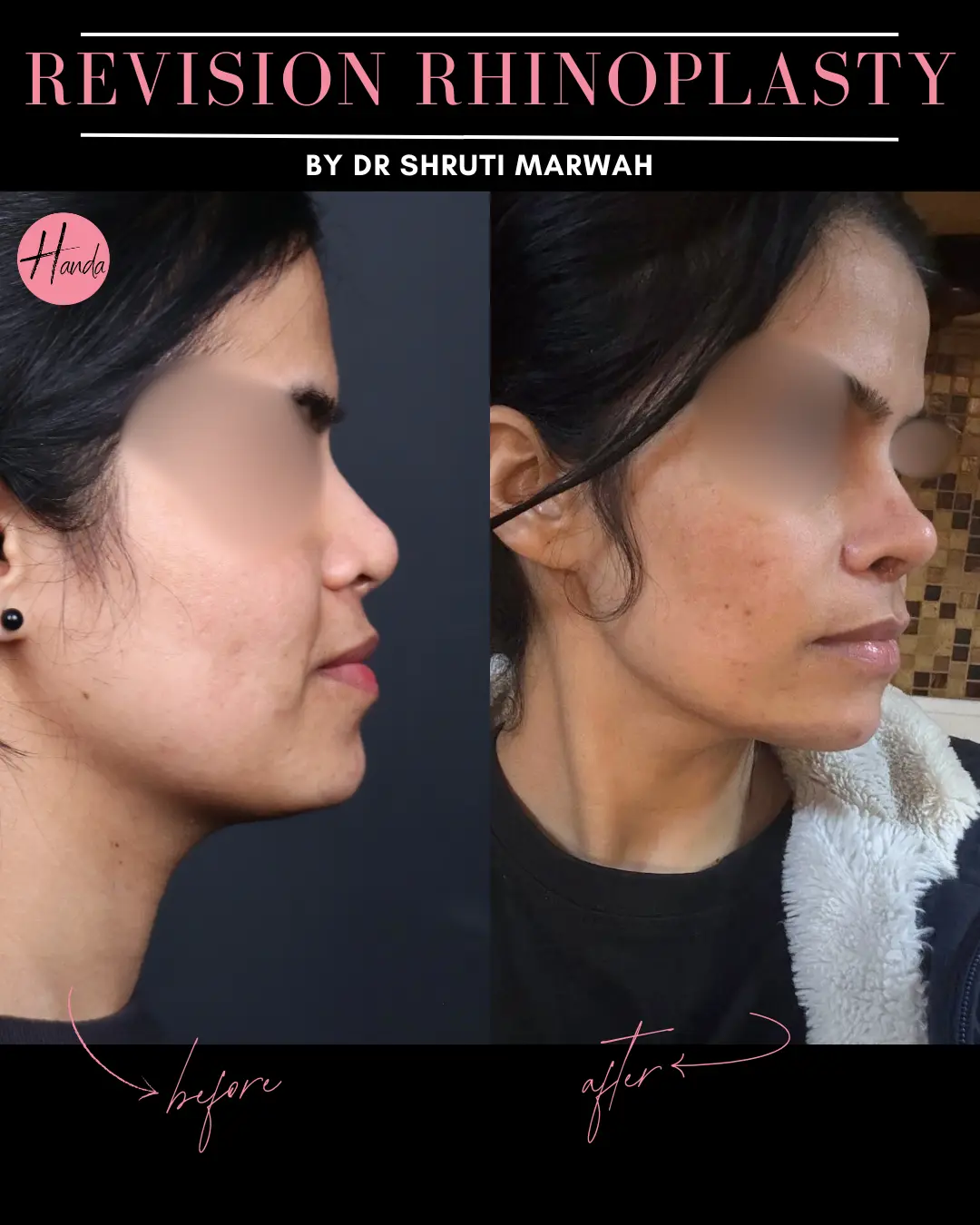 RHINOPLASTY before and after — Handa Aesthetics