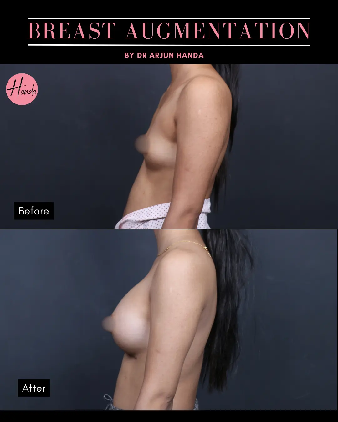 BREAST AUGMENTATION before and after — Handa Aesthetics