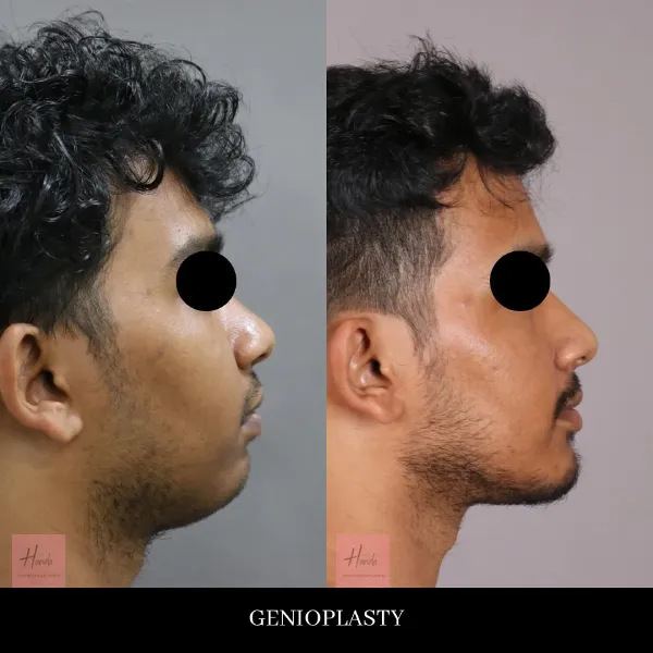 Face before and after — Handa Aesthetics
